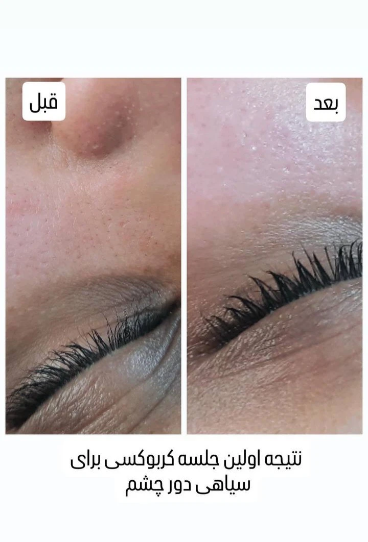پاکسازی پوست و فیشیال الهه ماه پروی
