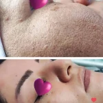 پاکسازی پوست و فیشیال الهه ماه پروی