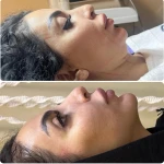 هایفو، فشیال، اسکالپ دکتر علی اکبری