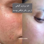  فیشیال و پاکسازی پوست رخشید