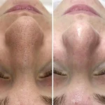 فیشال و پاکسازی پوست تخصصی بانوان نیلا