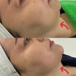 هایفو، فشیال، اسکالپ دکتر علی اکبری
