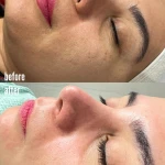 فیشال و پاکسازی پوست تخصصی بانوان نیلا